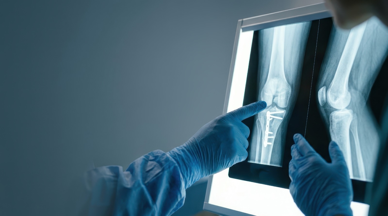 Evaluación radiográfica para cirugía de rodilla